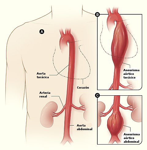 aneurisma aortico
