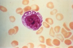 Micrograph depicts an atypical enlarged lymphocyte found in the blood smear from a hps patient