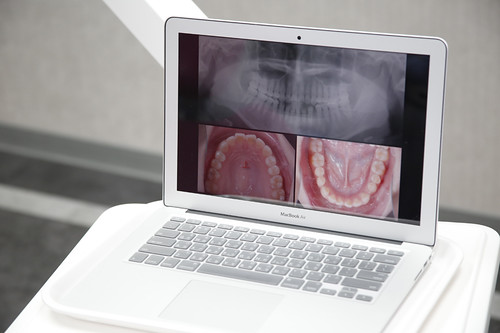 楊鎮瑋醫師分享三個觀念讓你的牙齒矯正結果更好看 (4)_矯正前X光